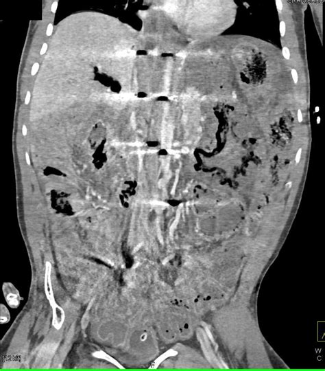 Infarcted Bowel With Portal Venous Gas And Pneumoperitoneum Small
