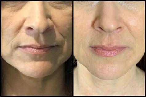 Fillers For Face Before And After Photos Before After Restylane