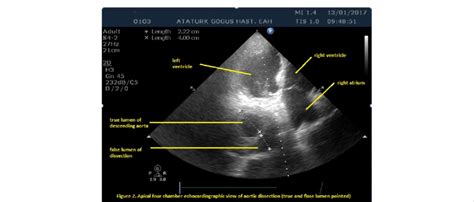 Apical Four Chamber Echocardiographic View Of Aortic Dissection True Download Scientific