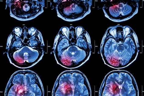 Primary Brain Tumor Types What To Know And Faqs