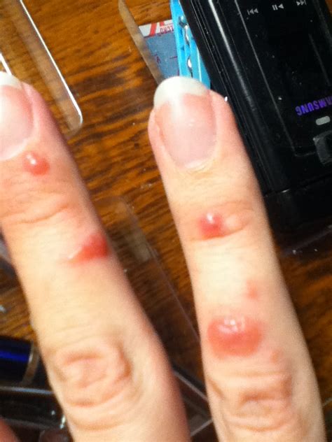 I Have Pus Filled Blisters On 3 Of My Right Hand Fingers Hives