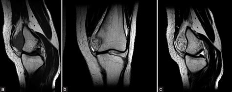 Intra Articular Synovial Hemangioma A Rare Cause Of Knee Pain And