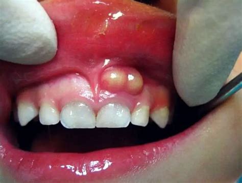 How To Take Care Of An Infected Tooth These Natural Remedies Should
