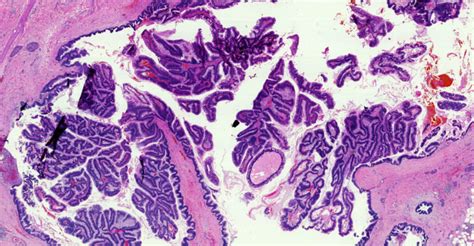 Pancreas Cysts Pancreatic Cancer Johns Hopkins Pathology