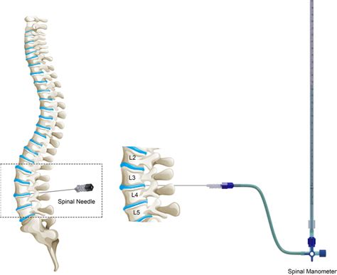 Csf Pressure Measurement Via Lumbar Puncture Is Ilustrated L2 L3 L4