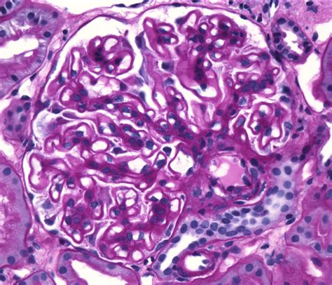 Glomerular And Vascular Diseases Membranous Nephropathy Renal And