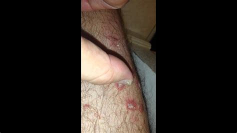Psoriasis On Toe And Picking Plaque Off On Leg Youtube