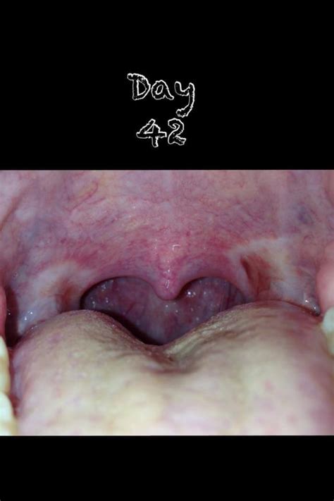 Tonsillectomy Scabs Pictures
