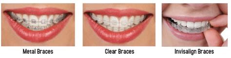 How Much Do Braces For Adults Cost Brier Creek Orthodontics