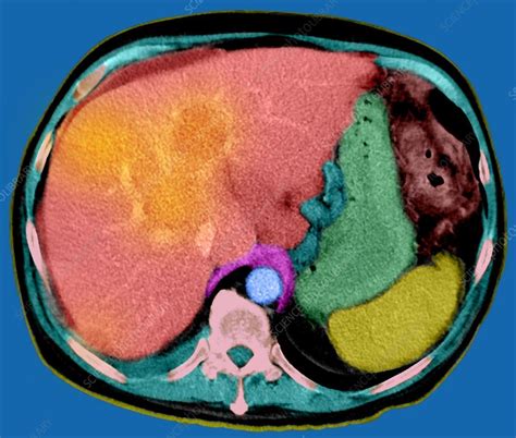 Liver Cancer Ct Scan Stock Image M1340521 Science Photo Library