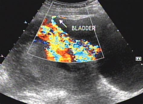 Placenta Accreta Spectrum Of Us And Mr Imaging Findings Radiographics