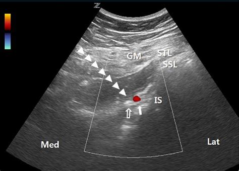 Management Of Pudendal Neuralgia Using Ultrasound Guided Pulsed