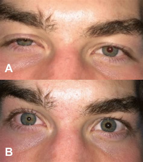 Horner S Syndrome After Block Placement With A Ptosis And B Miosis