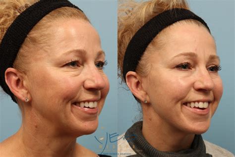 Face Fat Grafting Before After Photos Patient Vancouver Bc