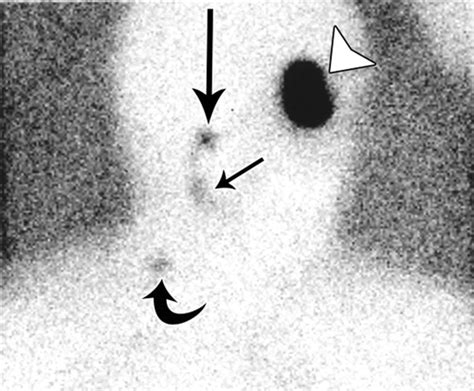 Lymphoscintigraphy In Cutaneous Melanoma An Updated Total Body Atlas