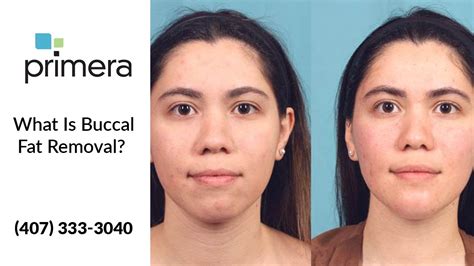 What Is Buccal Fat Removal Orlando Plastic Surgeon Dr Edward J