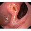 What Is The Appearance Of Duodenal Ulcers On Endoscopy