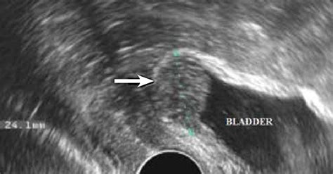 Transvaginal Ultrasonography In The Sagittal Plane Shows An