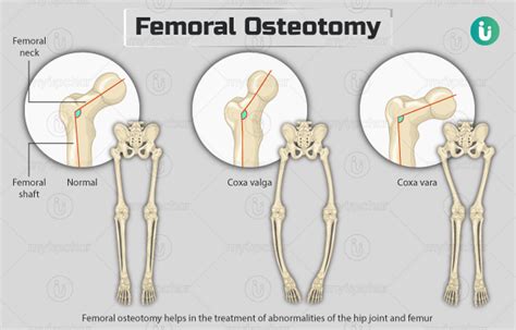 Proximal Femoral Osteotomy