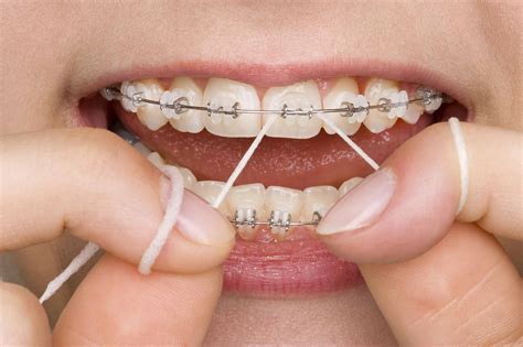 The Importance of Flossing (with Braces on!) | Orthodontist Toronto ...