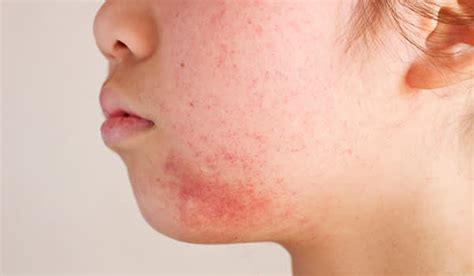 Allergic Eczema Treating Moderate To Severe Cases