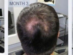 Scalp med is designed to grow hair faster and detoxify the scalp. Scalp Med win the Battle Against Hair Loss | Scalp med ...