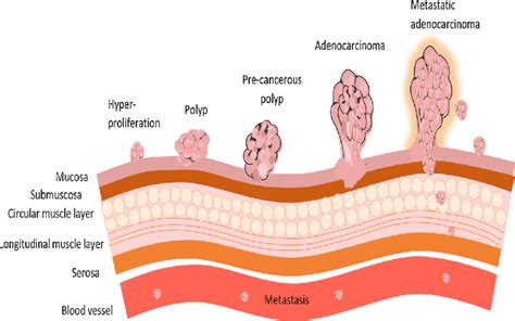 Stages Of Colorectal Cancer Hyperproliferation Of Epithelial Cells Download Scientific Diagram