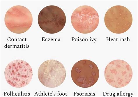 How To Identify And Treat Common Skin Allergies A Comprehensive Guide Revitalis