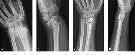 Figure 2 From Dorsal Nail Plate Fixation Of Distal Radius Fractures