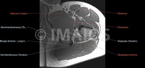 Hip Mri Anatomy