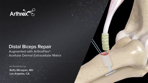 Arthrex Distal Biceps Repair Augmented With Arthroflex® Acellular