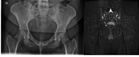 Bilateral Sacroiliitis SII Joint Space Narrowing And Sclerosis On