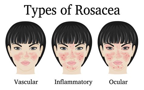 Rosacea And Ocular Rosacea Treatment Ophthalmologist Eye Health