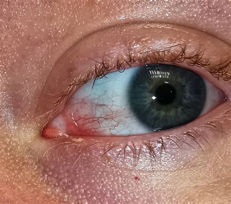 Eye Redness Eyetriage