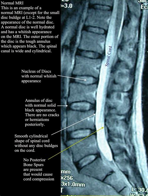 Mri Spine Lower Back Pain