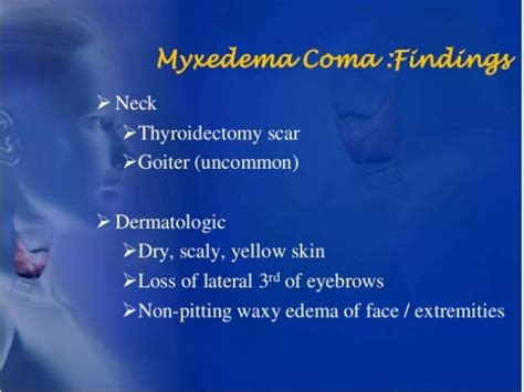Myxedema Coma