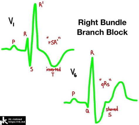 In Right Bundle Branch Block Rbbb The His Purkinje Conduction System