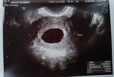 My Blighted Ovum Miscarriage Part 2