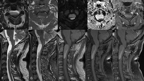 Case Of Cervical Spinal Neurenteric Cyst Mri Cervical Spine A E