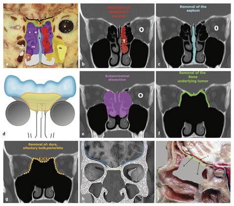 25 Malignant Skull Base Tumors Neupsy Key