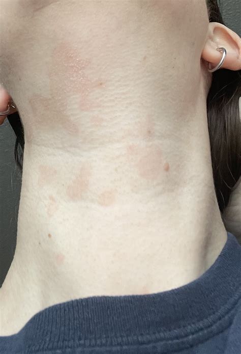 Itchy Neck Pink Splotches Infect Reaction Allergic Otc Health