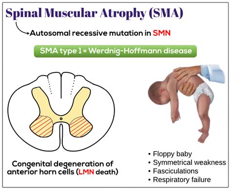 Spinal Muscular Atrophy Sma Medicine Keys For Mrcps