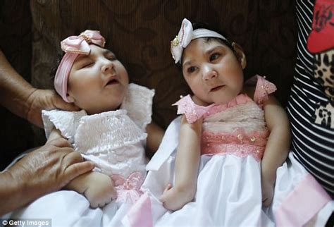 Brazilian Twins With Zika Celebrate Their First Birthday Daily Mail Online