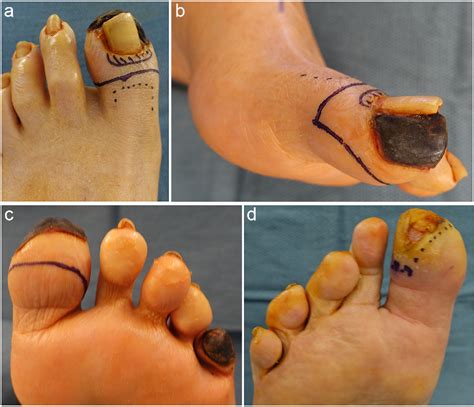 Distal Syme Hallux Amputation For Tip Of Toe Wounds And Gangrene