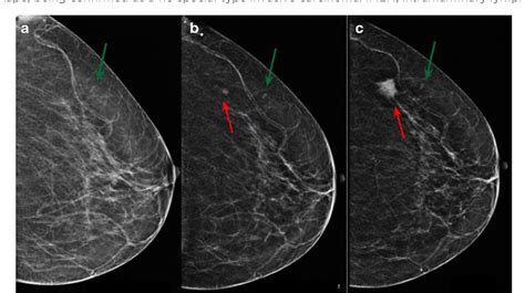 Intramammary Lymph Nodes Normal And Abnormal Multimodality Imaging