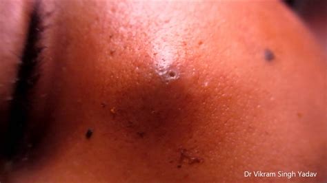 Big Infected Sebaceous Cyst Face Youtube