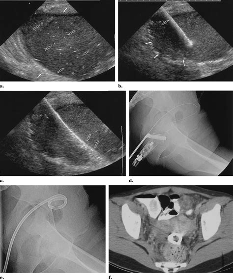 Imaging Guided Drainage Of An Appendiceal Abscess With The Seldinger