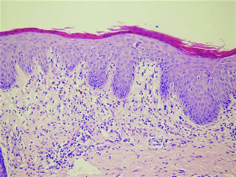 Histologic Examination Shows Spongiotic Dermatitis Lymphocytes