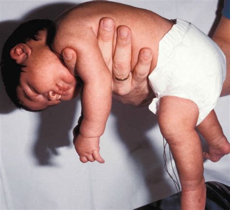 Floppy baby syndrome causes, signs, symptoms, diagnosis & treatment