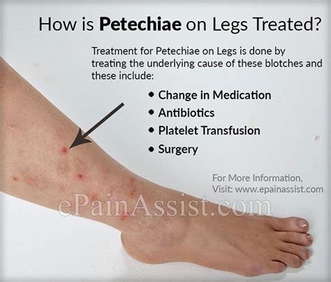 Petechiae Causes